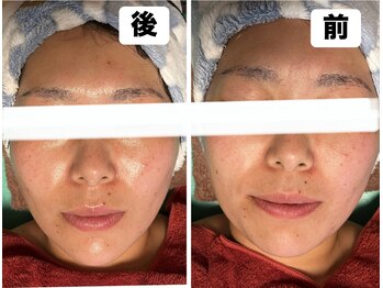 ローズ 下松(ROSE)/光フェイシャル初回