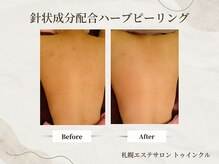 プライベートエステサロン トゥインクル/背中ニキビは早めに鎮静ケア