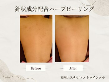 プライベートエステサロン トゥインクル/背中ニキビは早めに鎮静ケア
