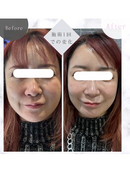 ブルーム(BL∞M)/若見え女優コース