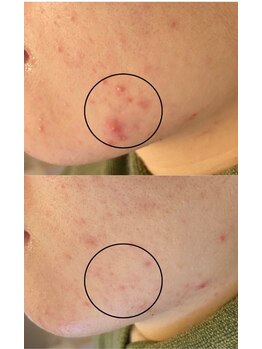 アトワ(A toi)/ハーブピーリング(棘あり)