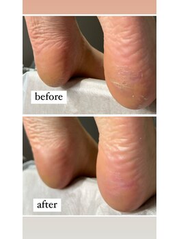 ビンナ 五反田店(Binna)/足裏角質自分で削らないで!