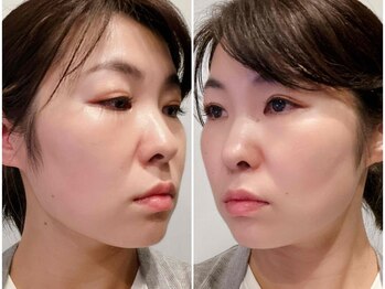 グリッタープラス(glitter plus)/耳つぼマッサージ