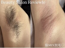 レビュール(Reviewle)の雰囲気（人気メニュー《脇MIX》一回の施術で効果抜群◎オススメ◎4,400円）
