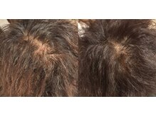 サナデア(Sanadea)/ヒト幹細胞培養液で育毛促進