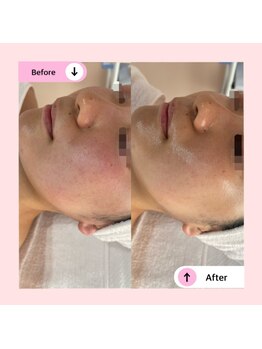 アネラ(ANELA)/乾燥　赤み