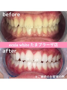 エクシアホワイトニング たまプラーザ店/ビフォーアフター