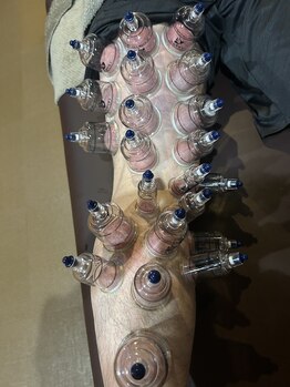 柔整 おがわ屋/カッピング　足