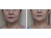 エステルーム まろん(marron)の雰囲気(口もと・フェイスラインに集中アプローチ♪)