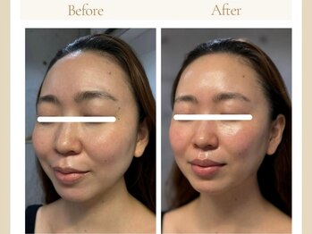 ミリュール(Millule)/大切なイベント前の駆け込み