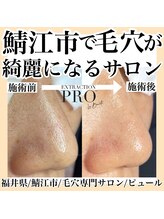 ピュール 鯖江店(PUR)/毛穴/毛穴ケア/毛穴洗浄