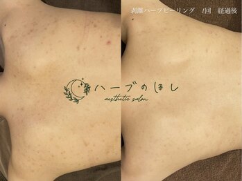 ハーブのほしの写真/挙式前の背中ケア・夏に向けて全身の肌質改善可☆ニキビや色沈ケア・色むら、ざらつきまで一気に変化