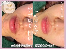 ハーバリー ハーブピーリング 大阪梅田店(HERBERRYハーブピーリング)/梅田ハーブピーリングHERBERRY
