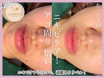 ハーバリー ハーブピーリング 大阪梅田店(HERBERRYハーブピーリング)/梅田ハーブピーリングHERBERRY