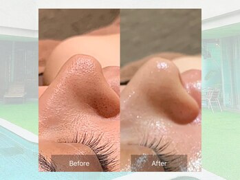 ベルゼ 渋谷店(BELZE)/ハイドロ毛穴洗浄☆