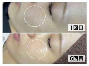 モテ美白/シミケアあて放題!