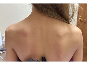 スキンケアスタジオ アコ 新宿店(Aco)/背中キャビテーションラジオ波後