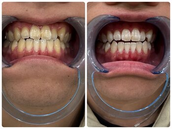 コナホワイトニング 神保町/ホワイトニング