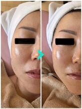 ミルキー(Milky)/顎のポニョは喰いしばりが原因