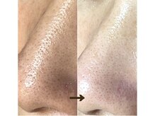 カミーシャ(KaMi-Sha)/【40代女性】毛穴改善症例写真