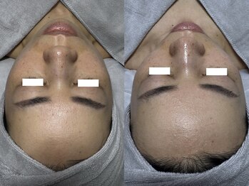 ナチュールムーン(Nature moon.)/ハーブピーリング