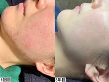 アンドミー 横浜(&me)/赤み肌にお悩みの方にもおすすめ