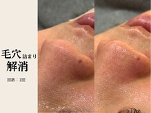 サロン ルイス アディクト(salon Lewis Addict)/毛穴洗浄