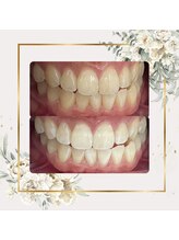 プラチナムビューティー 鳥取店(platinum beauty)/ナチュラルホワイトニング￥2970