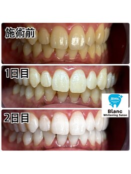 ブラン 心斎橋店(Blanc)/120分を2回でここまで白く