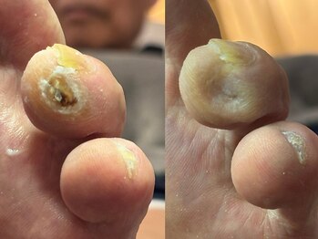 ルーム ノヘア(Room nohea)/【フットケア】魚の目