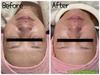 クルル(KROL)の写真/そのくすみ、諦めていませんか？だんだん濃くなるモヤっとしたムラも無かったことにできますよ～～～！