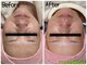 クルル(KROL)の写真/そのくすみ、諦めていませんか？だんだん濃くなるモヤっとしたムラも無かったことにできますよ～～～！