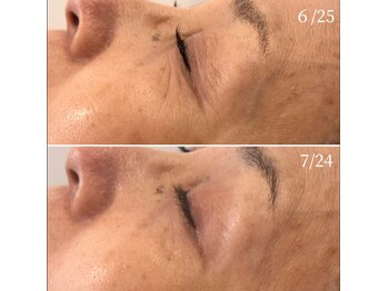 エービューティーサロン 松山店(A BEAUTY SALON.)の写真/【４０．５０代小じわ・シミ】大人のハーピーリング♪衰えた肌細胞を瞬時に活性化！隠す肌から魅せる肌へ。