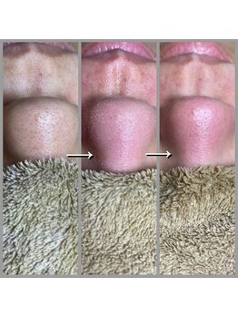 キコ リラクゼーションサロン(KICO by PLUS)/毛穴エクストラクション