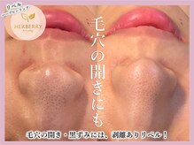 ハーバリー ハーブピーリング 大阪梅田店(HERBERRYハーブピーリング)/リベル・REVI・クリスティーナ