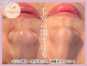 ハーバリー ハーブピーリング 大阪梅田店(HERBERRYハーブピーリング)/リベル・REVI・クリスティーナ