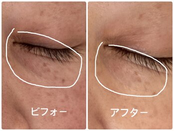 ノーブル シャット Noble Chate/目の下のたるみも美容機でケア