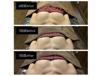 リノレア(LinoLea)/バストアップBefore after