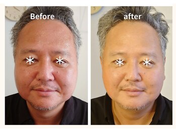 テノヒラ 横浜中華街店(tenohira)/小顔オイルコース　before after