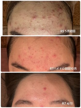 エステティックサロン ベルエトワール住吉店/ニキビにお悩みの方へ