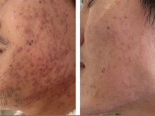 ナチュラルセラピー ドロップ(Drop)/ニキビが落ち着いた肌改善例