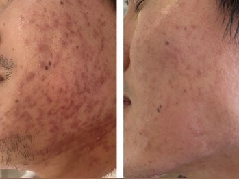 ナチュラルセラピー ドロップ(Drop)/ニキビが落ち着いた肌改善例