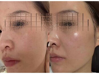 ナチュラ ソース(NatureSouce)の写真/韓国で話題のララピールで毛穴洗浄して、うるおい溢れるツルツル肌へ!ツヤ感UPが期待できる人気サロン。
