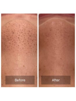 ハニー(Honey)/毛穴の汚れザラツキ気になる方