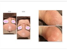 バニーヒップ(Bunny Hip)/カーボキシー