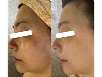 マスカレード 品川(Masquerade)/【症例写真】施術1回