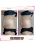 人気NO1【脂肪冷却】1カップ☆今流行の冷やして脂肪を減少◇初回お試し￥8000