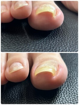 リリ(lili)/巻き爪矯正2回目(右親指)