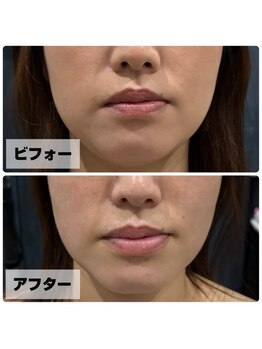 ほねつぎ 平成けやき通り鍼灸接骨院/πテラピー ビフォー/アフター4