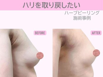 ぷるるんエステ/ハーブピーリング/バストケア